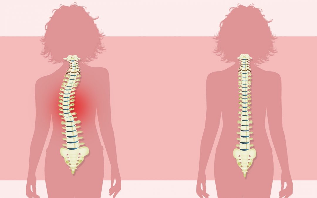 Chiropractic and Scoliosis